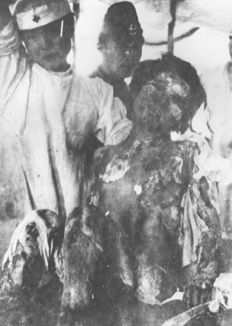 Hiroshima Radiation Victim